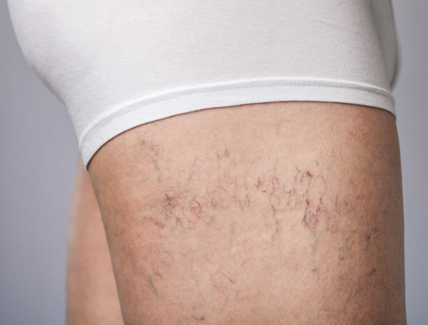 Vein Sclerotherapy